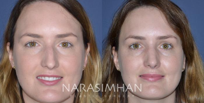 Before & After Rhinoplasty Case 333 Front View in Tampa, Florida