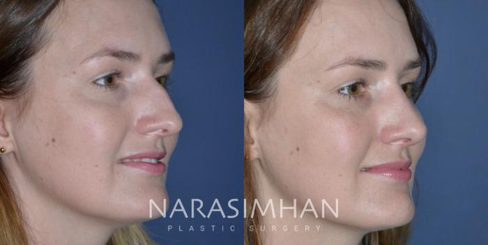 Before & After Rhinoplasty Case 333 Right Oblique View in Tampa, Florida