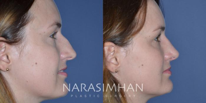 Before & After Rhinoplasty Case 333 Right Side View in Tampa, Florida