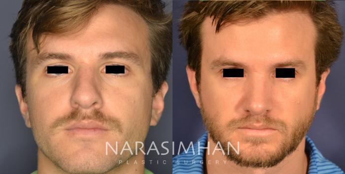 Before & After Rhinoplasty Case 335 Front View in Tampa, Florida