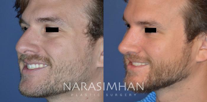 Before & After Rhinoplasty Case 335 Left Oblique View in Tampa, Florida