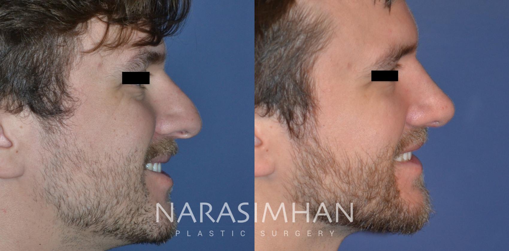 Before & After Rhinoplasty Case 335 Right Side View in Tampa, Florida