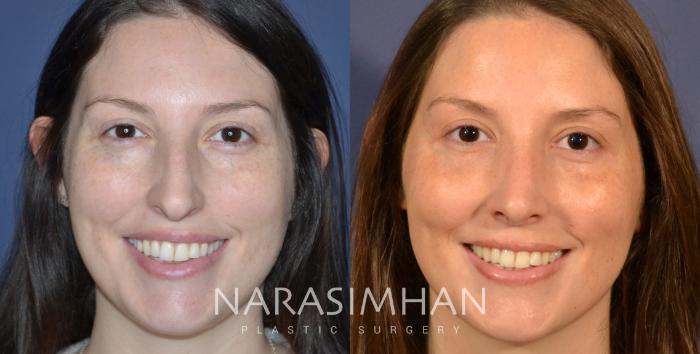 Before & After Rhinoplasty Case 336 Front View in Tampa, Florida