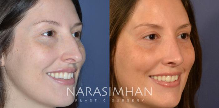 Before & After Rhinoplasty Case 336 Right Oblique View in Tampa, Florida