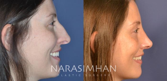 Before & After Rhinoplasty Case 336 Right Side View in Tampa, Florida