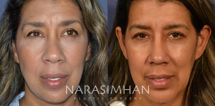 Before & After Rhinoplasty Case 337 Front View in Tampa, Florida