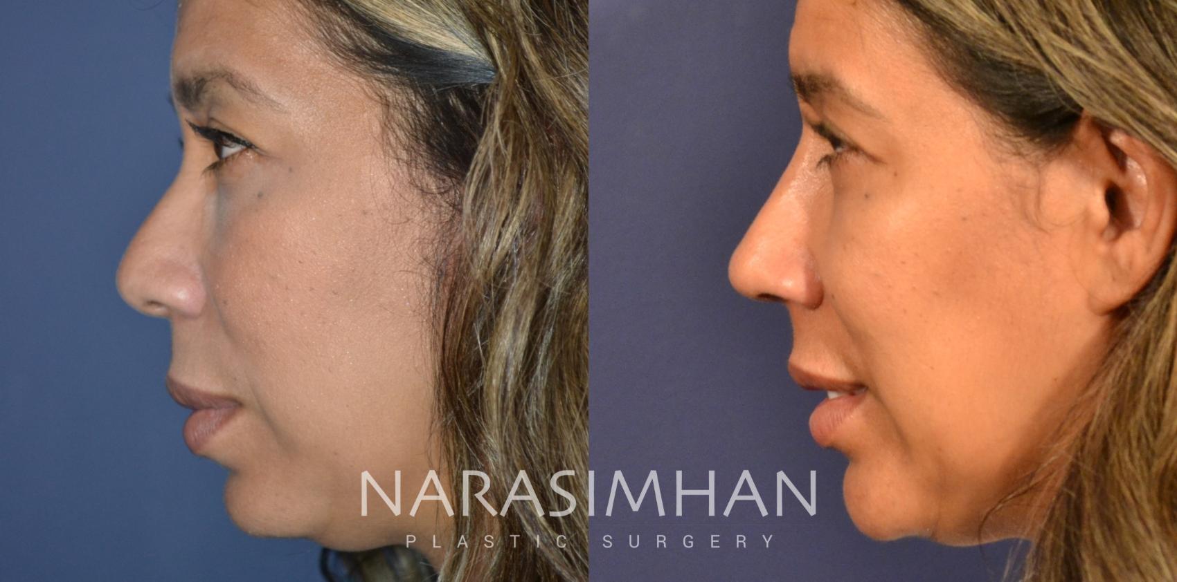 Before & After Rhinoplasty Case 337 Left Side View in Tampa, Florida