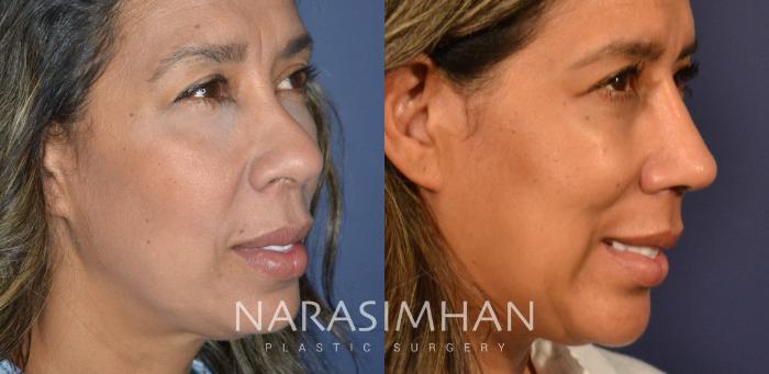 Before & After Rhinoplasty Case 337 Right Oblique View in Tampa, Florida
