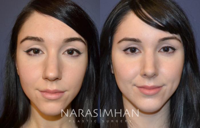 Before & After Rhinoplasty Case 97 View #1 View in Tampa, Florida