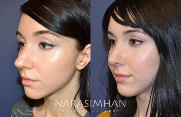 Before & After Rhinoplasty Case 97 View #2 View in Tampa, Florida