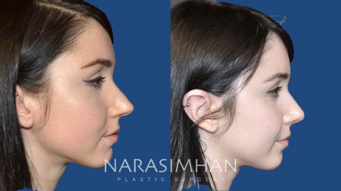 Before & After Rhinoplasty Case 97 View #3 View in Tampa, Florida