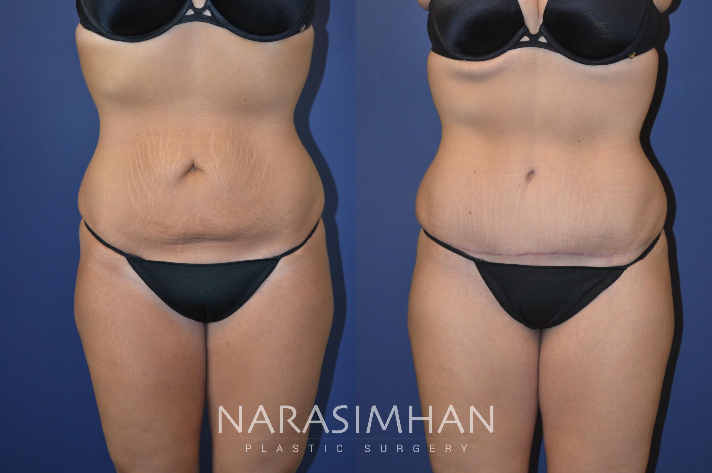 Before & After Tummy Tuck (Abdominoplasty) Case 108 View #1 View in St Petersburg, Florida
