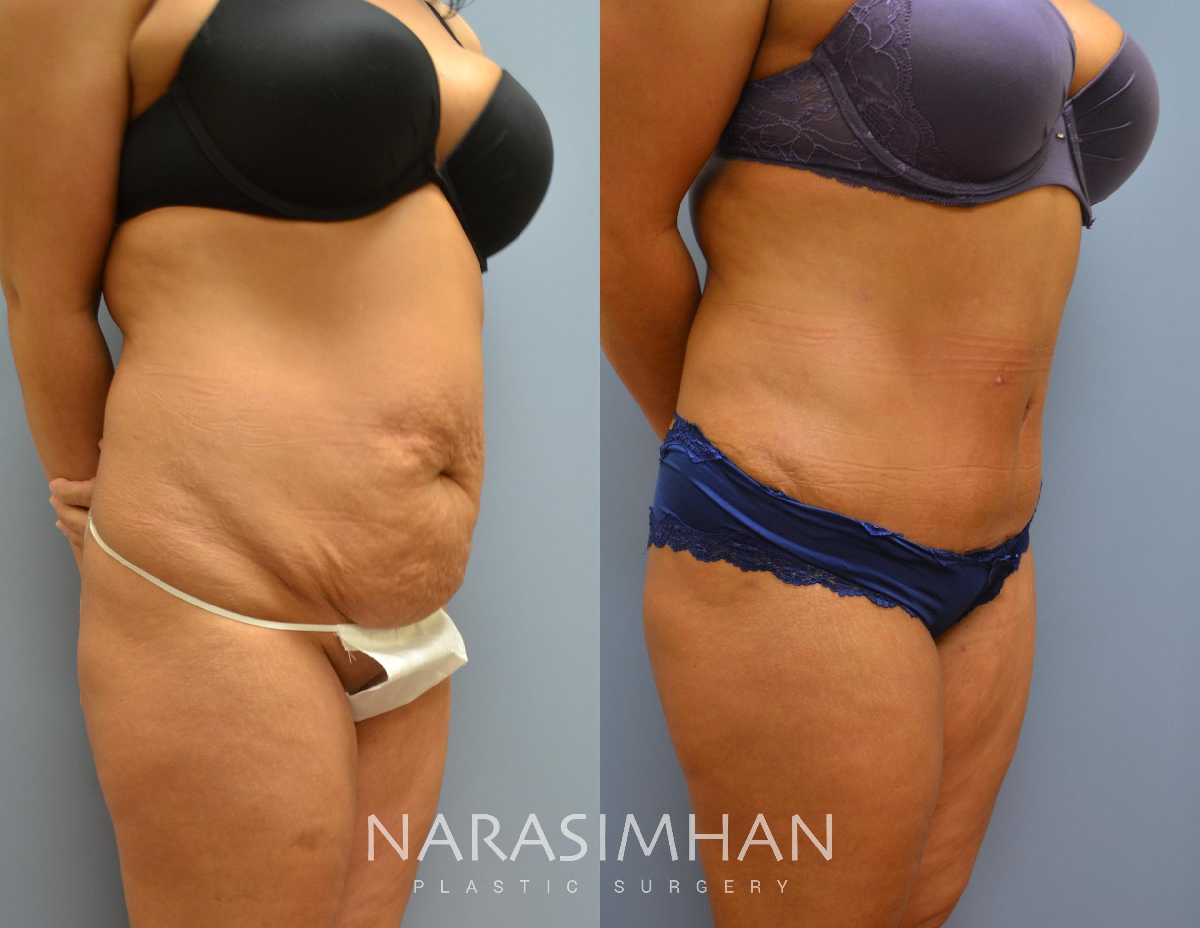 Before & After Tummy Tuck (Abdominoplasty) Case 13 View #1 View in St Petersburg, Florida