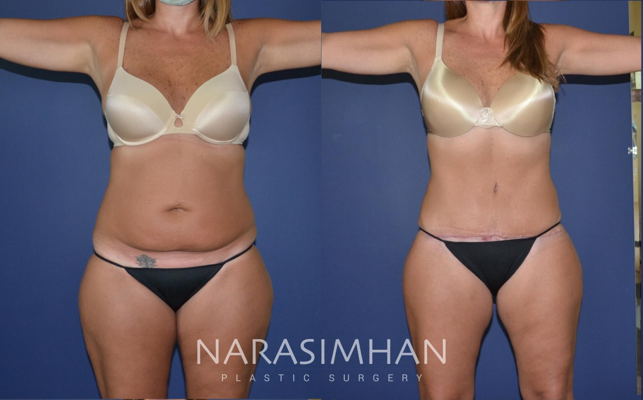 Before & After Tummy Tuck (Abdominoplasty) Case 179 View #1 View in St Petersburg, Florida