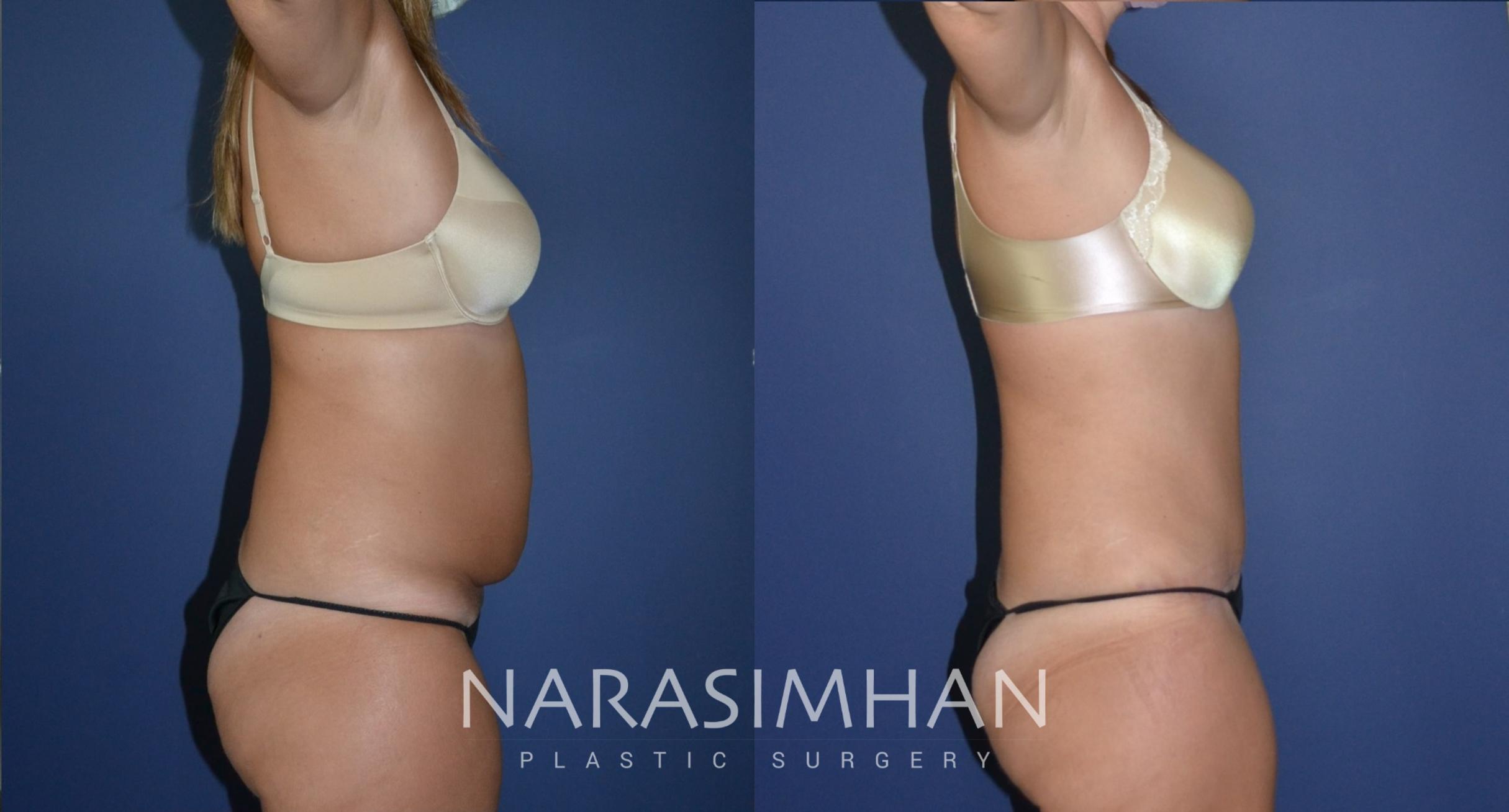 Before & After Tummy Tuck (Abdominoplasty) Case 179 View #2 View in St Petersburg, Florida
