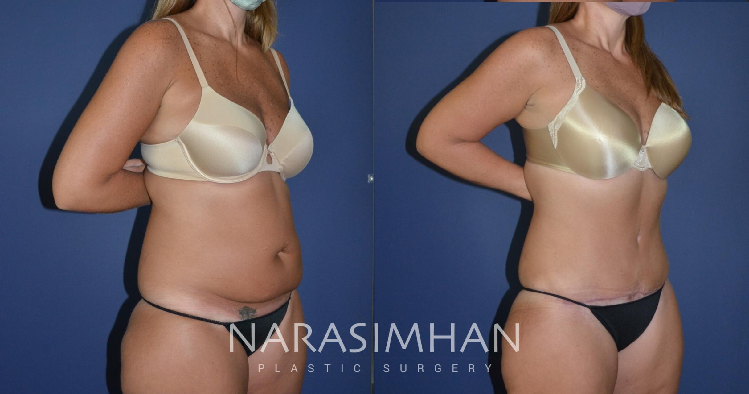 Before & After Tummy Tuck (Abdominoplasty) Case 179 View #3 View in St Petersburg, Florida