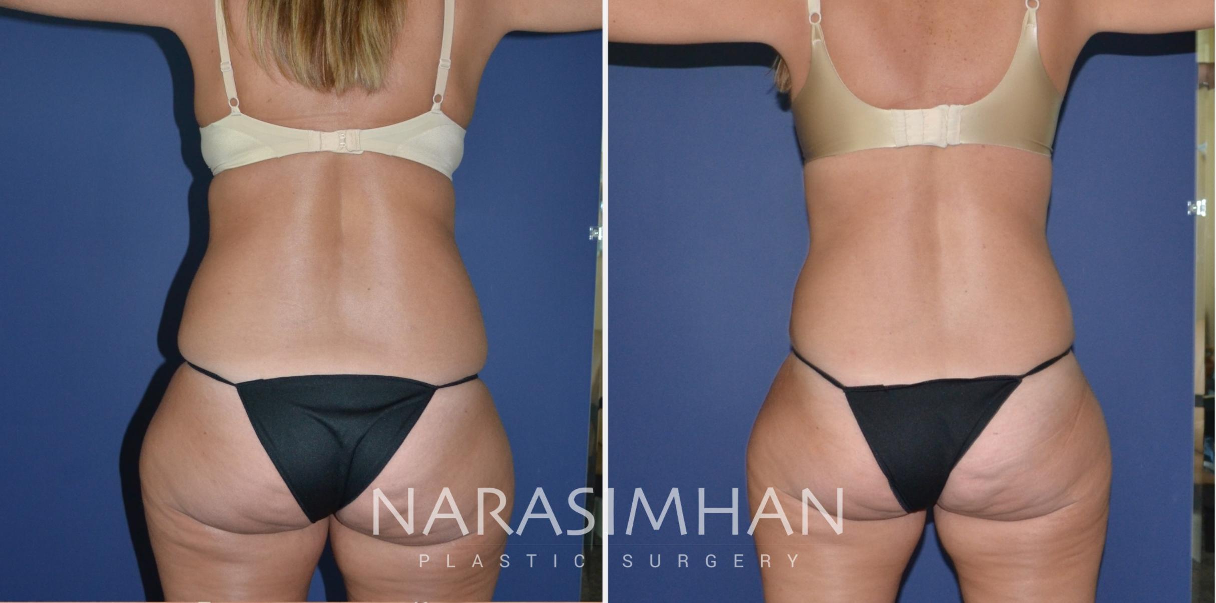 Before & After Tummy Tuck (Abdominoplasty) Case 179 View #4 View in St Petersburg, Florida