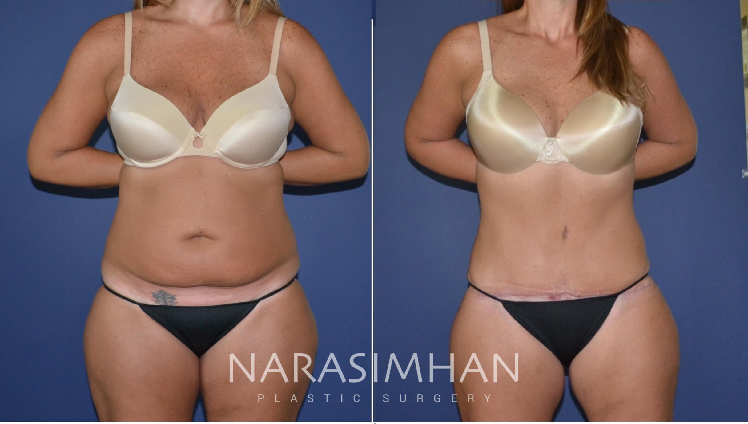 Before & After Tummy Tuck (Abdominoplasty) Case 179 View #5 View in St Petersburg, Florida
