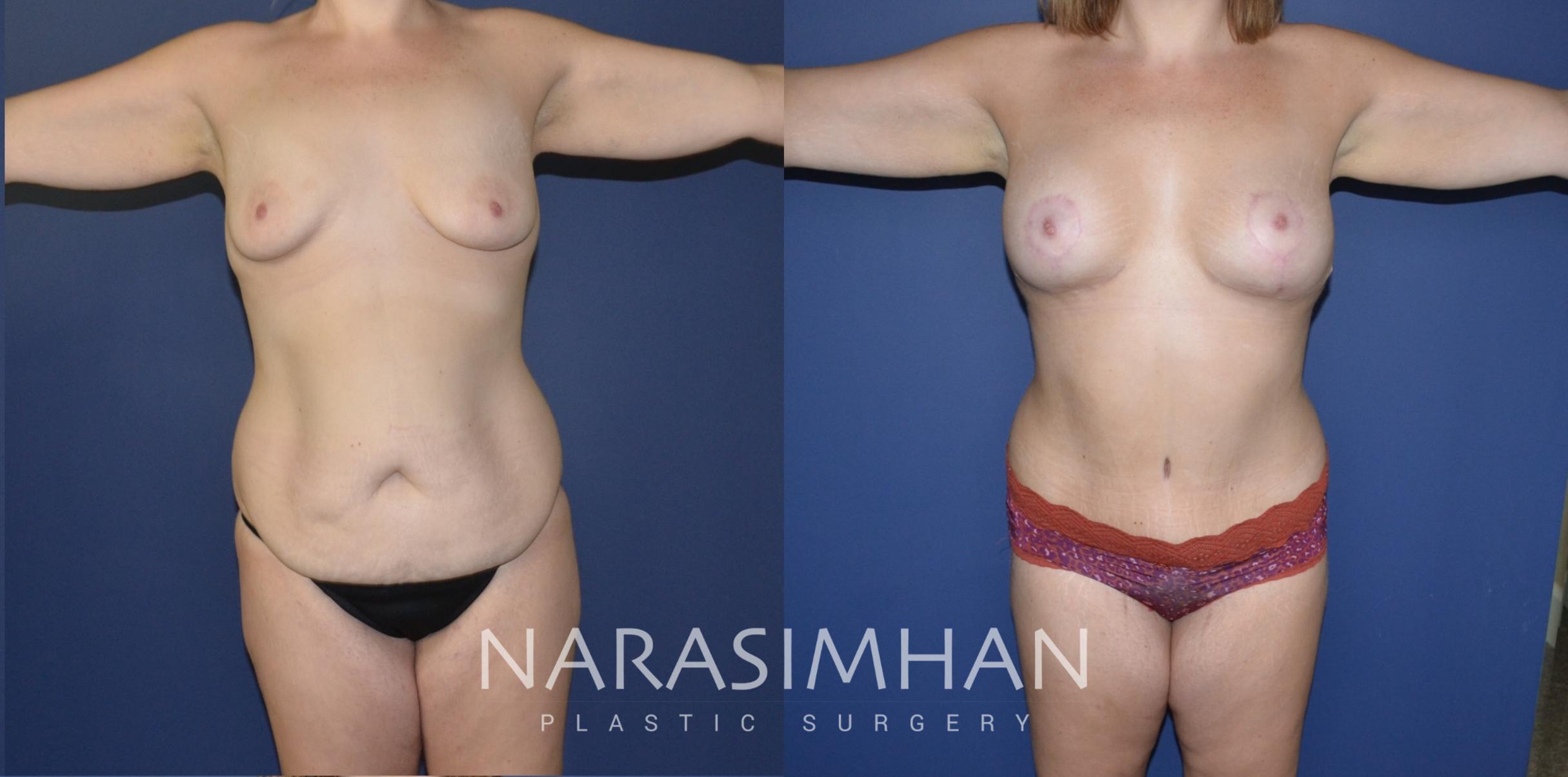 Before & After Post-Weight Loss / Post-Bariatric Skin Tightening Case 193 View #1 View in St Petersburg, Florida