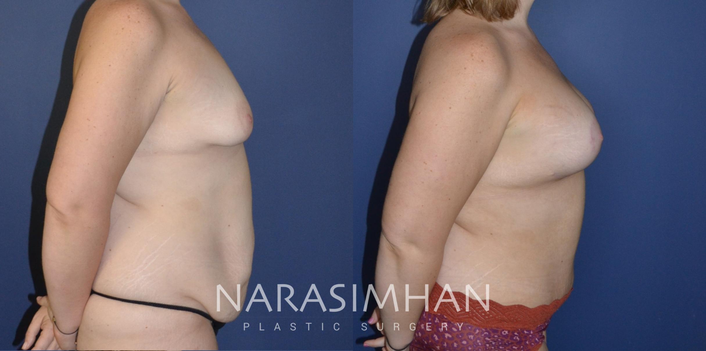 Before & After Tummy Tuck (Abdominoplasty) Case 193 View #2 View in St Petersburg, Florida