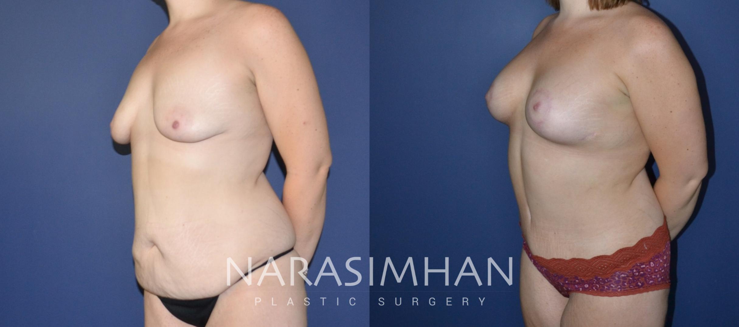 Before & After Tummy Tuck (Abdominoplasty) Case 193 View #3 View in St Petersburg, Florida
