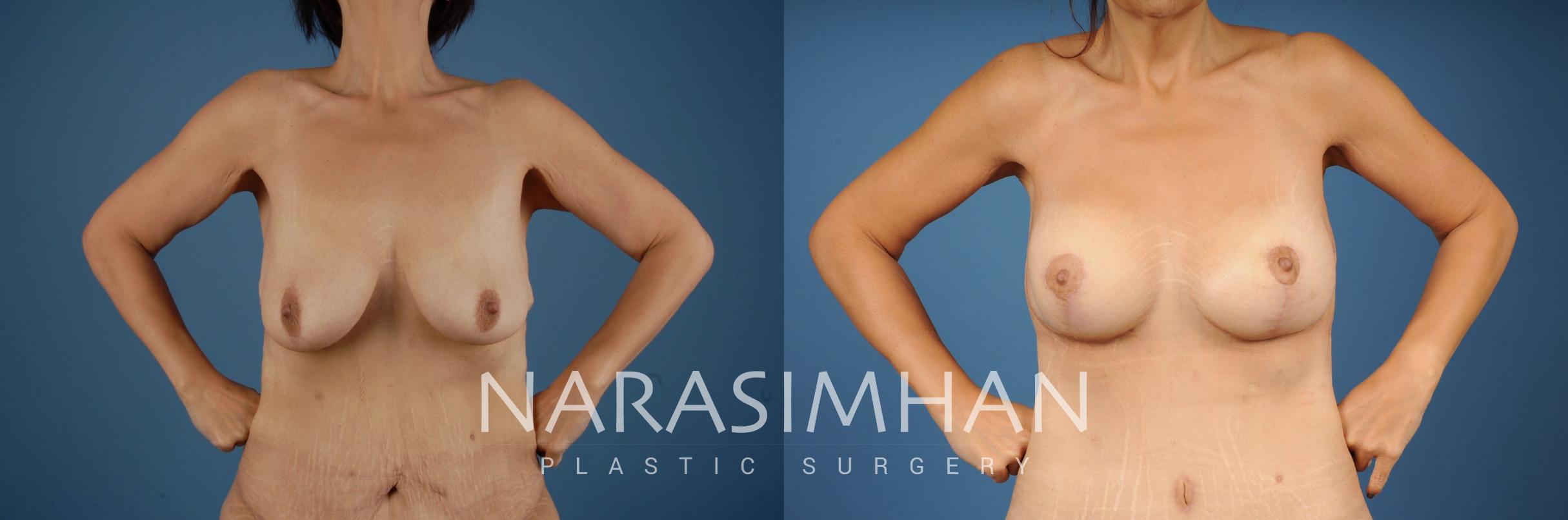 Before & After Post-Weight Loss / Post-Bariatric Skin Tightening Case 208 View #1 View in St Petersburg, Florida