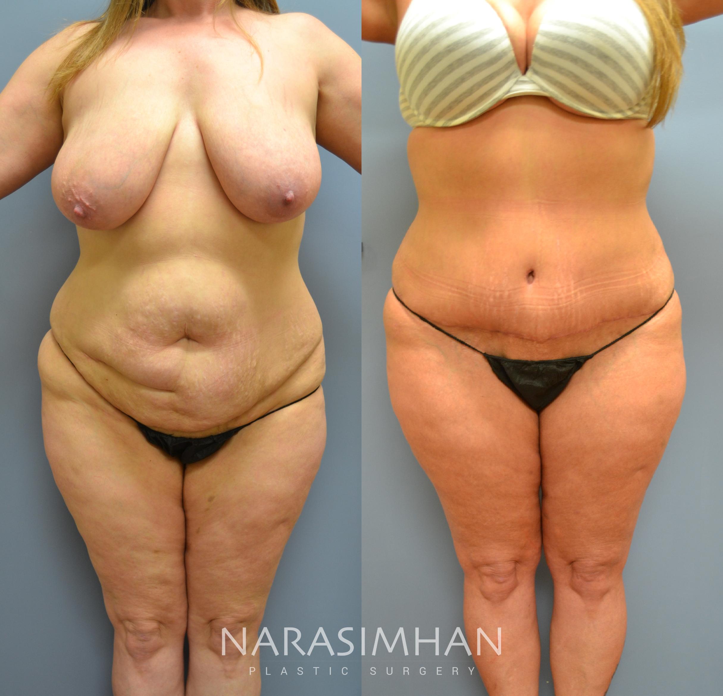 Before & After Tummy Tuck (Abdominoplasty) Case 36 View #1 View in St Petersburg, Florida