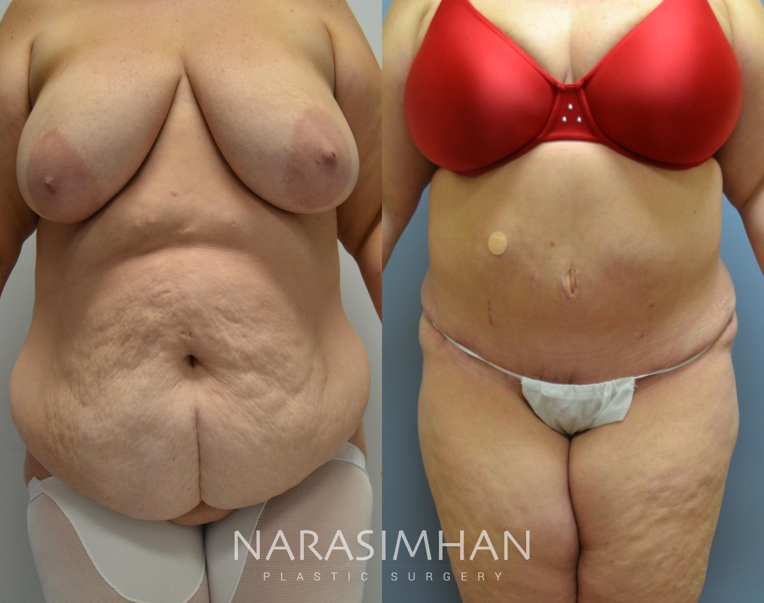 Before & After Tummy Tuck (Abdominoplasty) Case 37 View #1 View in St Petersburg, Florida