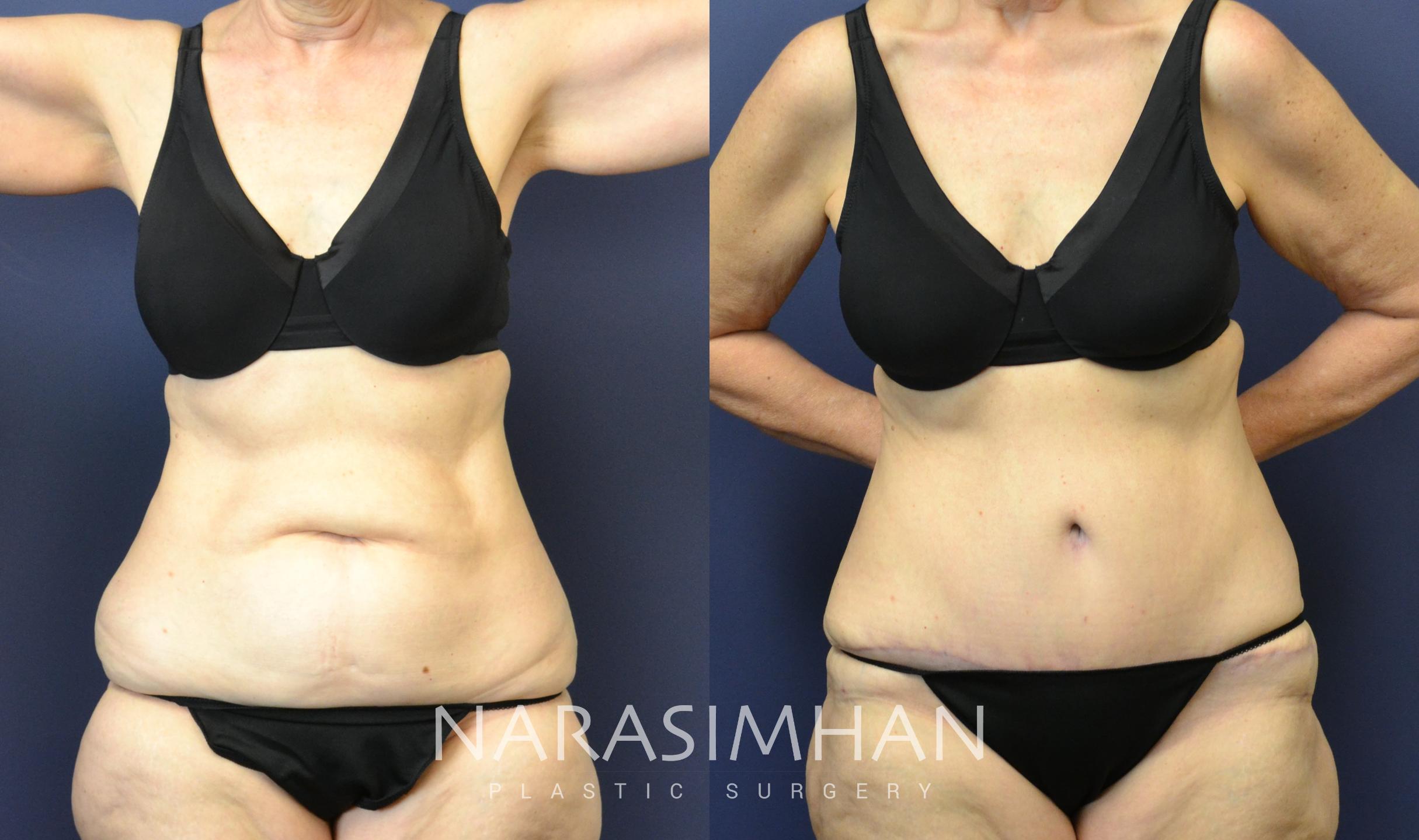 Before & After Tummy Tuck (Abdominoplasty) Case 72 View #1 View in St Petersburg, Florida