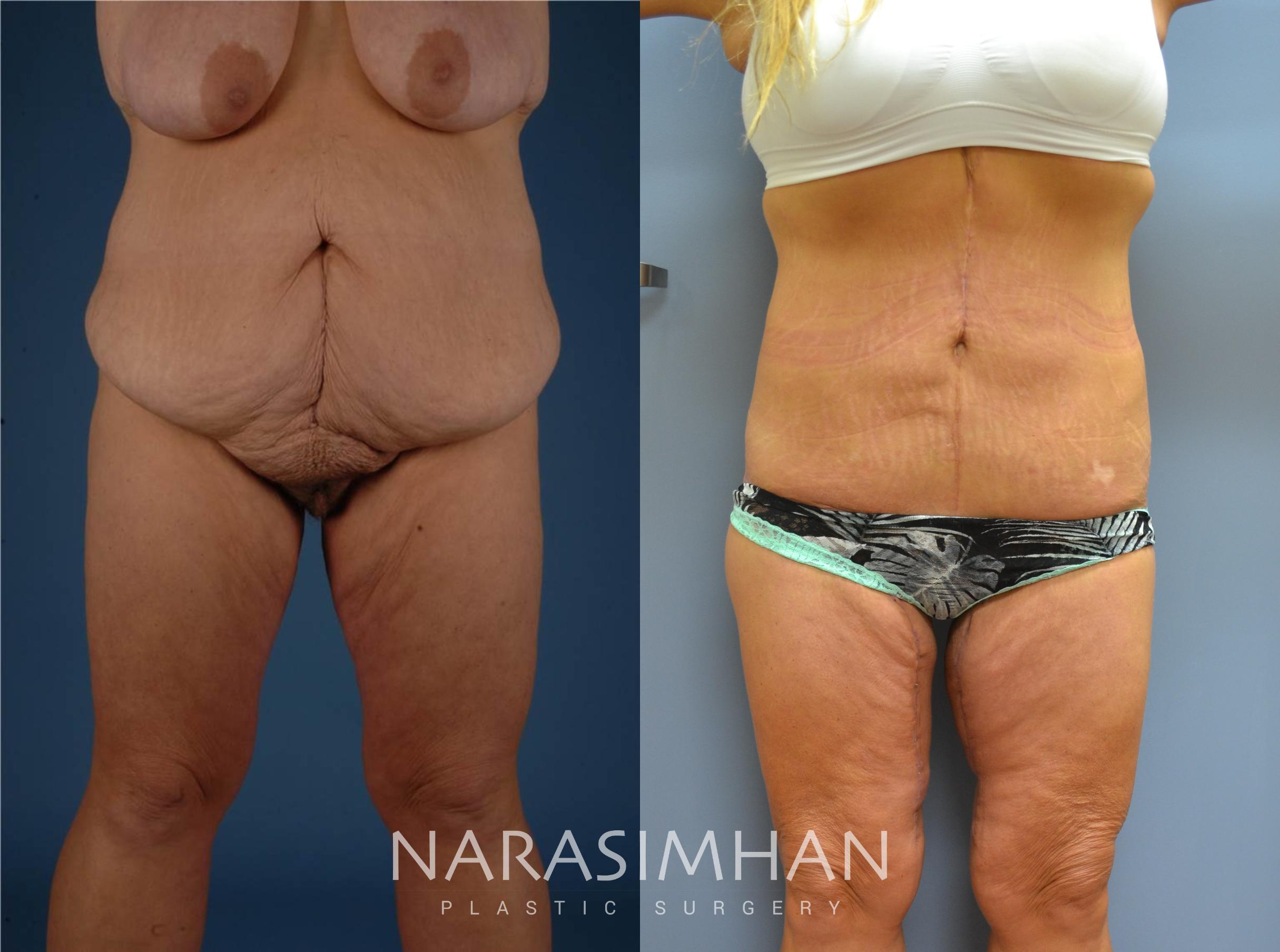 Before & After Thighplasty Case 75 View #1 View in St Petersburg, Florida