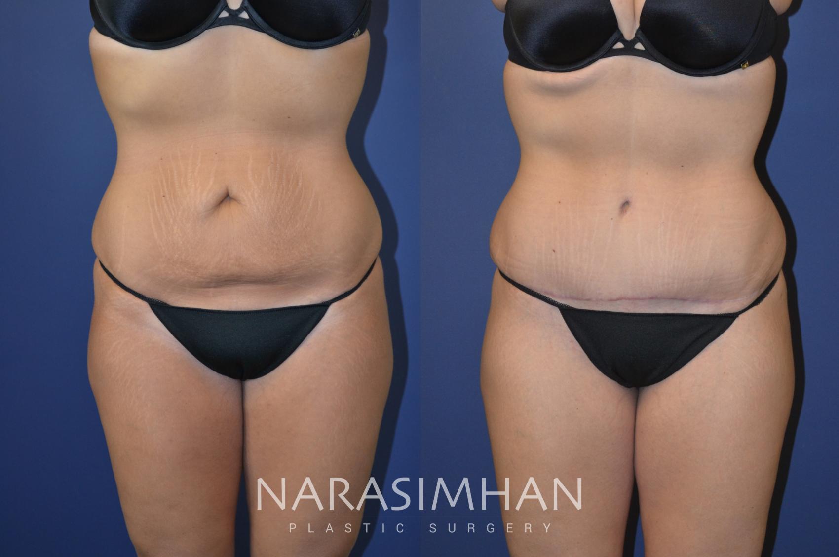 Before & After Tummy Tuck (Abdominoplasty) Case 108 View #1 View in Tampa, Florida