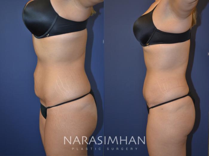 Before & After Tummy Tuck (Abdominoplasty) Case 108 View #2 View in Tampa, Florida