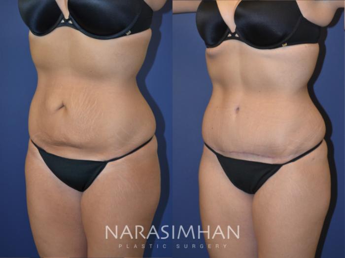 Before & After Tummy Tuck (Abdominoplasty) Case 108 View #3 View in Tampa, Florida