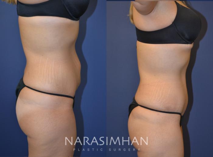 Before & After Tummy Tuck (Abdominoplasty) Case 108 View #5 View in Tampa, Florida