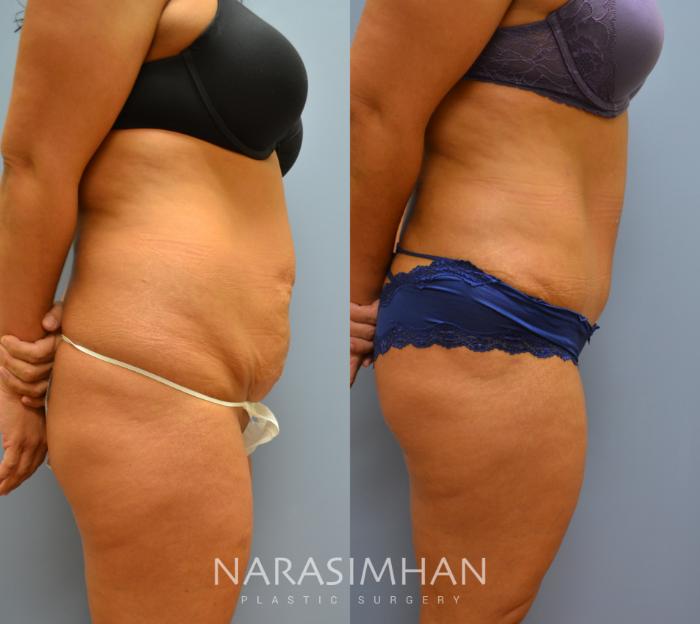 Before & After Tummy Tuck (Abdominoplasty) Case 13 View #2 View in Tampa, Florida