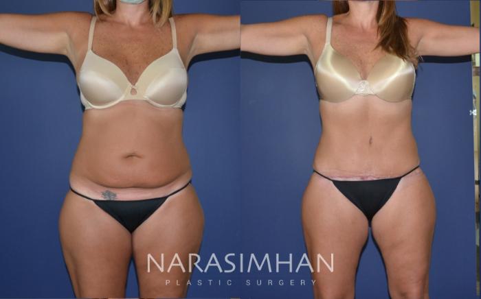 Before & After Tummy Tuck (Abdominoplasty) Case 179 View #1 View in Tampa, Florida