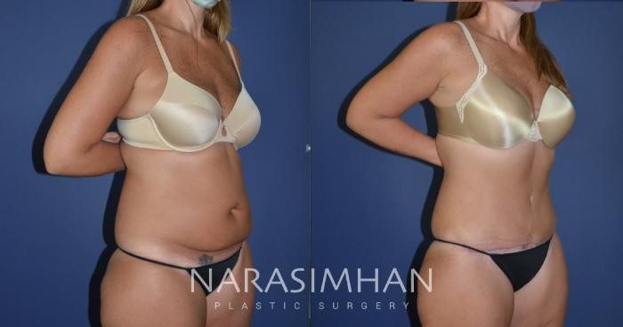 Before & After Tummy Tuck (Abdominoplasty) Case 179 View #3 View in Tampa, Florida