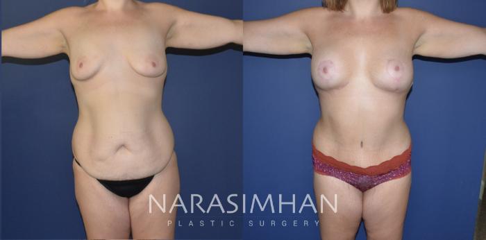Before & After Post-Weight Loss / Post-Bariatric Skin Tightening Case 193 View #1 View in St Petersburg, Florida