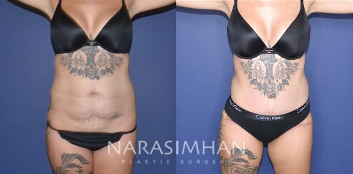 Before & After Tummy Tuck (Abdominoplasty) Case 194 View #1 View in Tampa, Florida