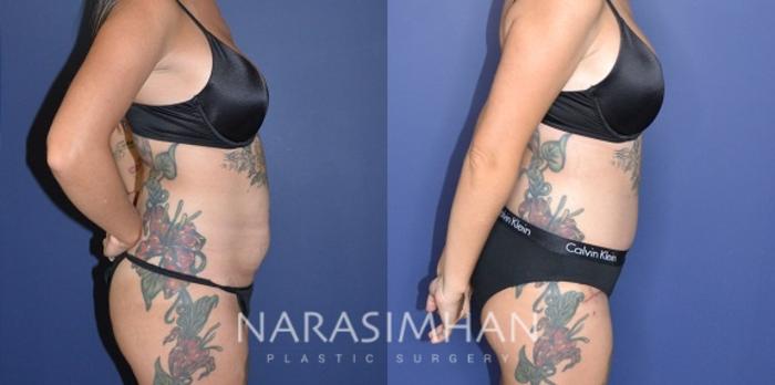 Before & After Tummy Tuck (Abdominoplasty) Case 194 View #3 View in Tampa, Florida