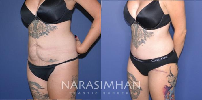 Before & After Tummy Tuck (Abdominoplasty) Case 194 View #4 View in Tampa, Florida
