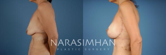 Before & After Post-Weight Loss / Post-Bariatric Skin Tightening Case 208 View #3 View in St Petersburg, Florida