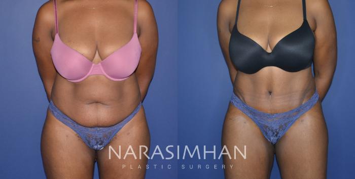 Before & After Liposuction Case 222 View #1 View in Tampa, Florida