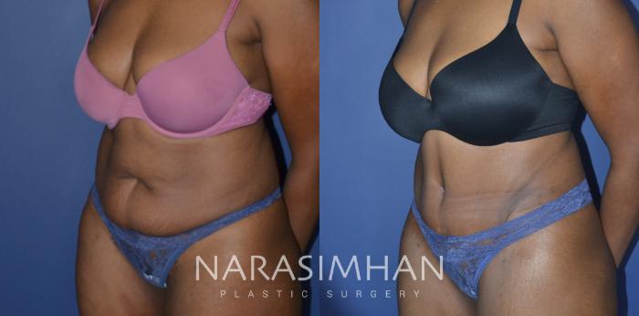 Before & After Tummy Tuck (Abdominoplasty) Case 222 View #2 View in Tampa, Florida