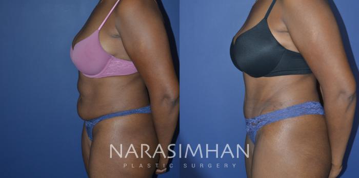 Before & After Tummy Tuck (Abdominoplasty) Case 222 View #3 View in Tampa, Florida