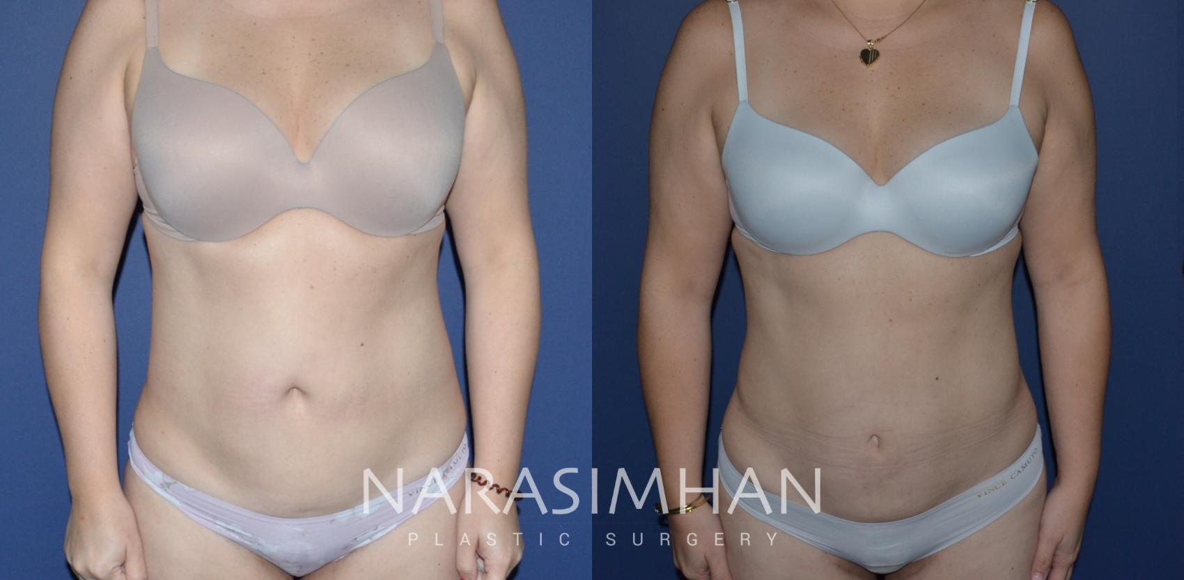 Before & After Tummy Tuck (Abdominoplasty) Case 235 View #1 View in Tampa, Florida