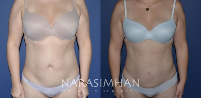 Before & After Tummy Tuck (Abdominoplasty) Case 235 View #1 View in Tampa, Florida