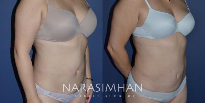Before & After Tummy Tuck (Abdominoplasty) Case 235 View #2 View in Tampa, Florida