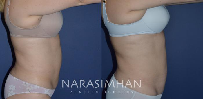 Before & After Tummy Tuck (Abdominoplasty) Case 235 View #3 View in Tampa, Florida