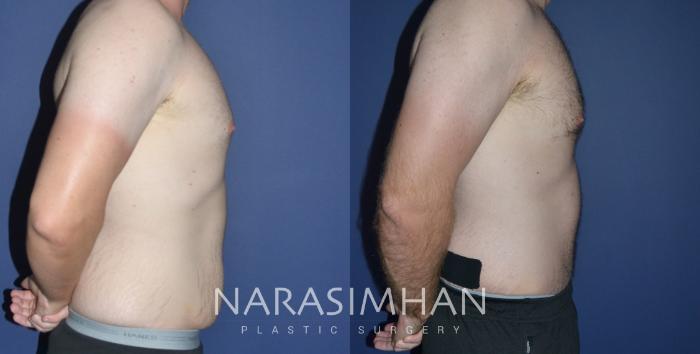 Before & After Tummy Tuck (Abdominoplasty) Case 236 View #4 View in Tampa, Florida